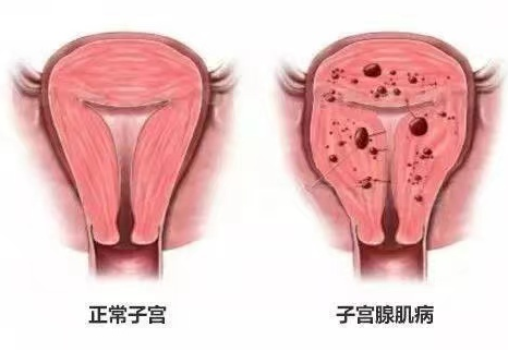 子宫腺肌症