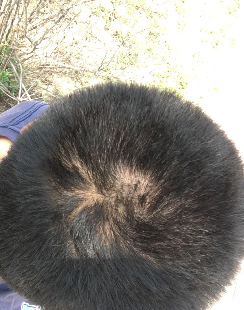 肾虚脱发 肾虚脱发