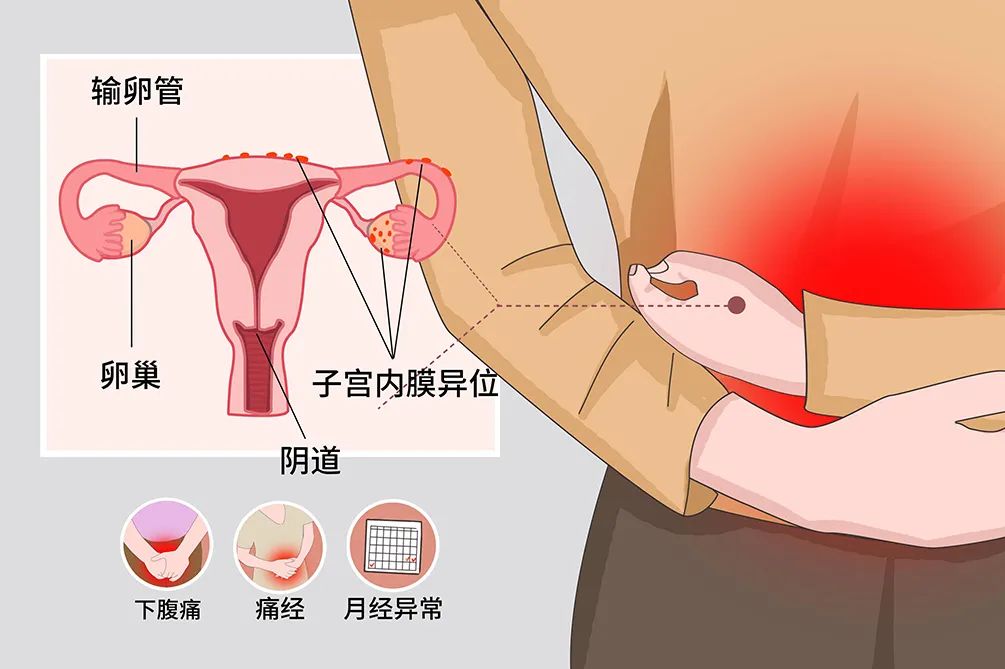 子宫内膜异位征 子宫内膜异位征
