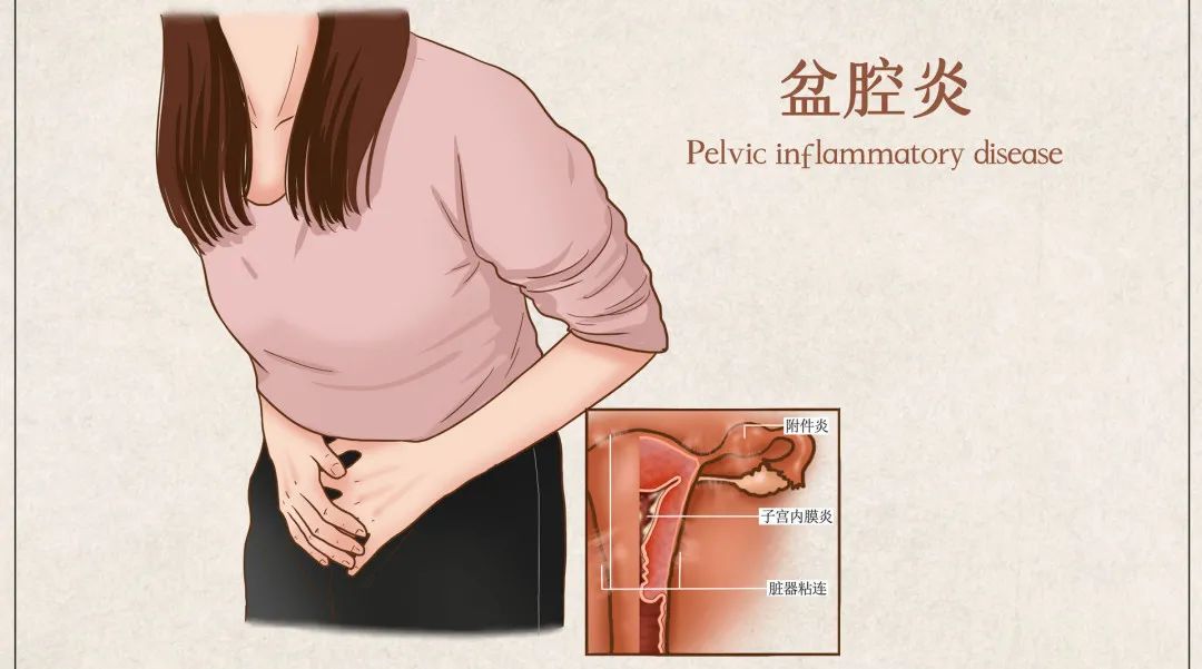 慢性盆腔炎 慢性盆腔炎
