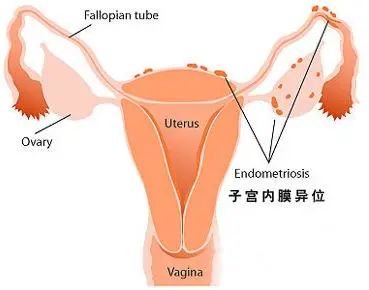 子宫内膜异位征