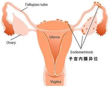 子宫内膜异位征 子宫内膜异位征