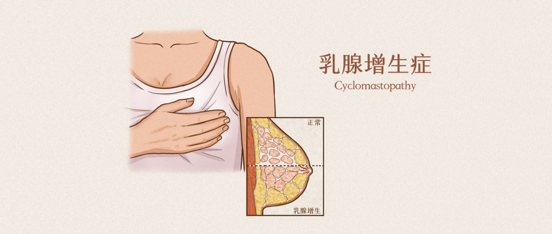 乳腺增生