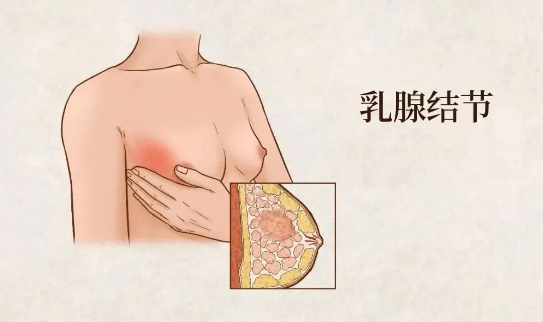 乳腺结节