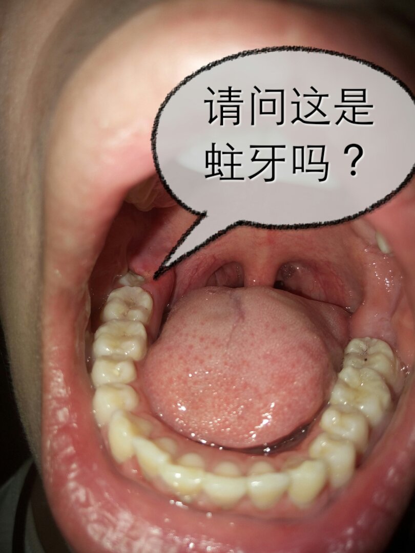 牙齿酸痛 牙齿酸痛
