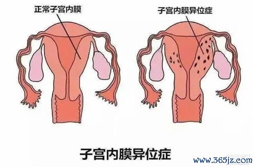 子宫内膜异位症 子宫内膜异位症