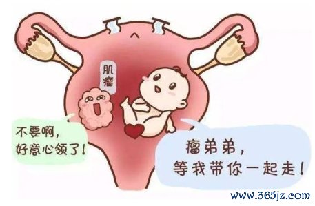 子宫肌瘤 子宫肌瘤