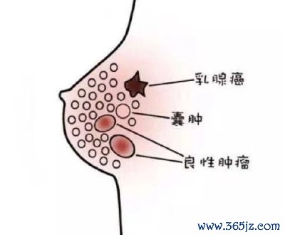 乳腺增生 乳腺增生
