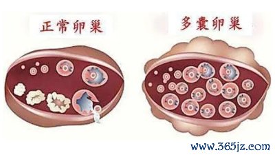 多囊卵巢 多囊卵巢